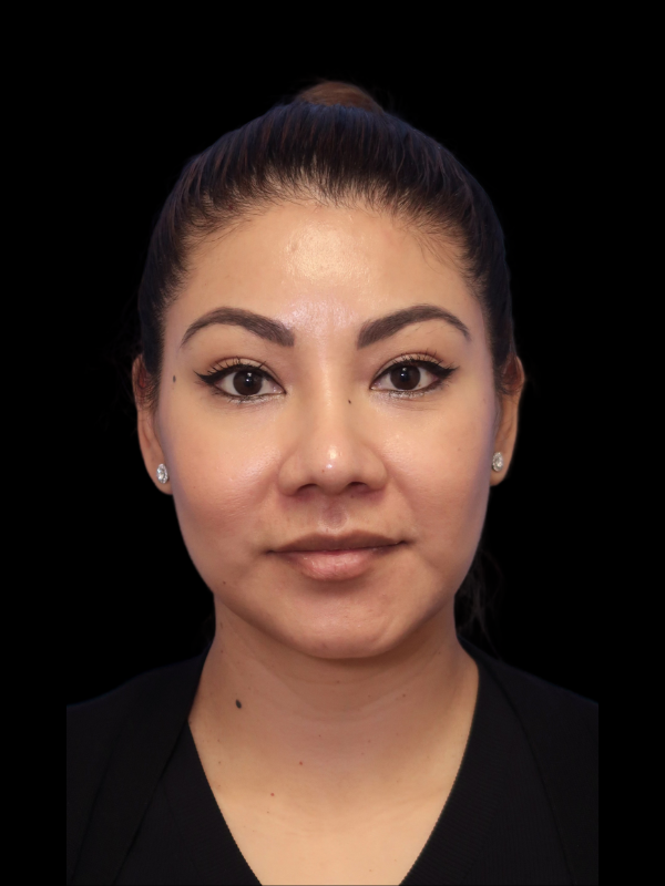 Rhinoplasty Before & After