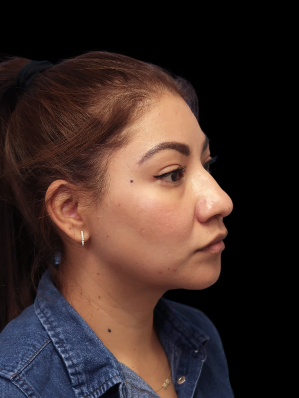 Rhinoplasty Before & After