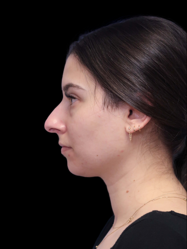Rhinoplasty Before & After