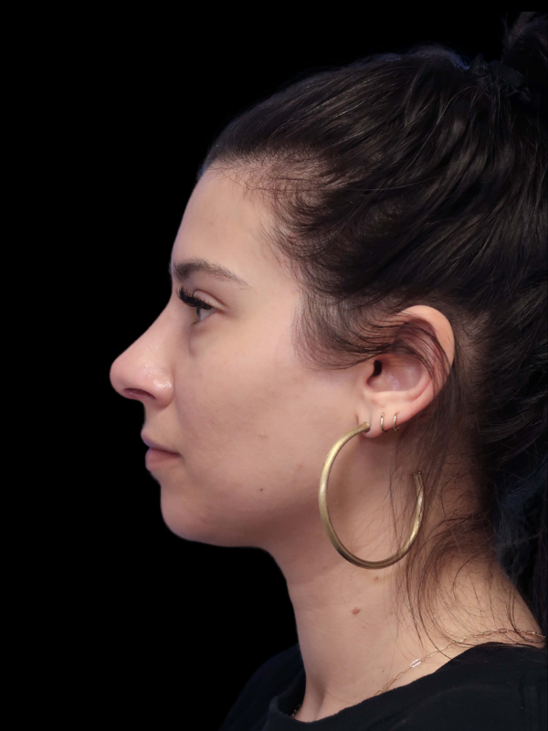 Rhinoplasty Before & After