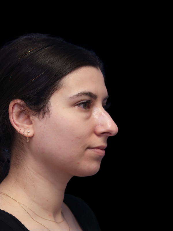 Rhinoplasty Before & After