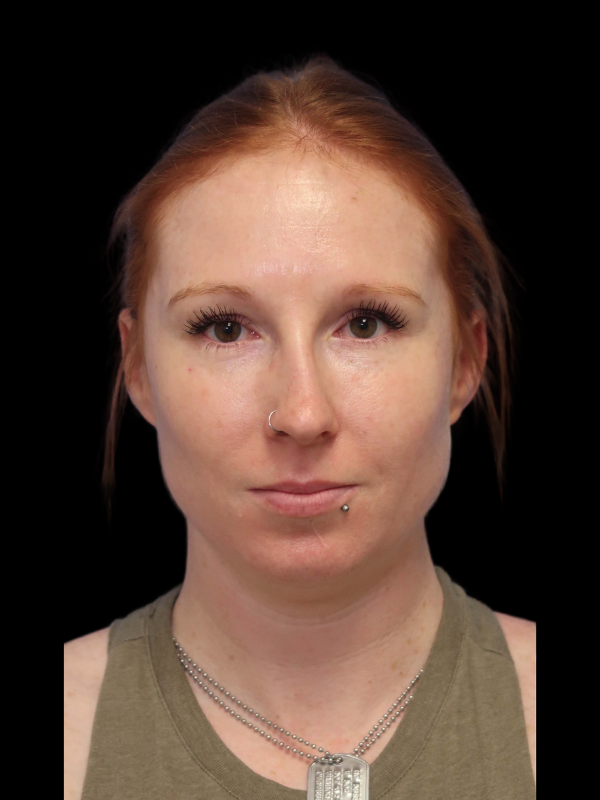 Rhinoplasty Before & After