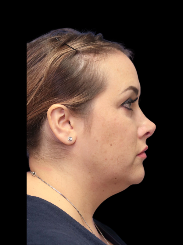 Rhinoplasty Before & After