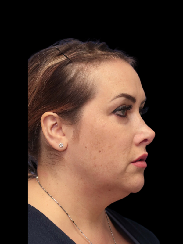 Rhinoplasty Before & After