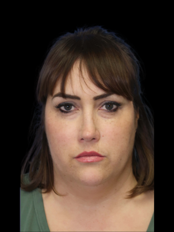 Rhinoplasty Before & After