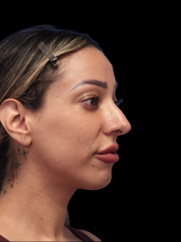 Rhinoplasty Before & After