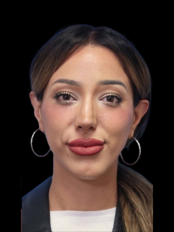 Rhinoplasty Before & After