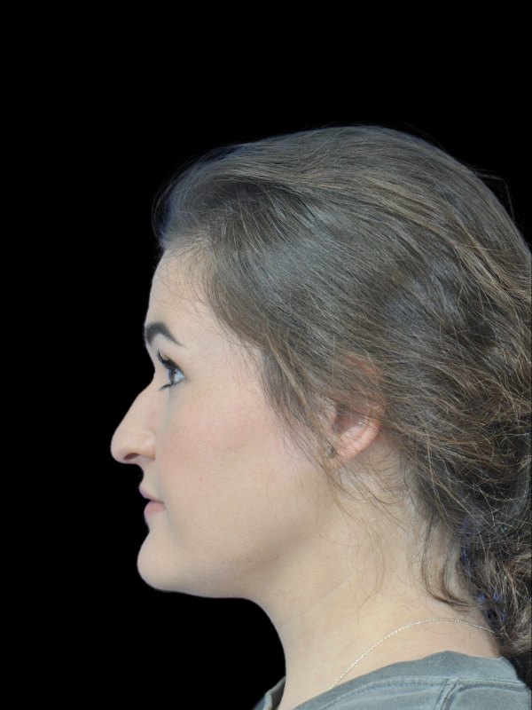 Rhinoplasty Before & After