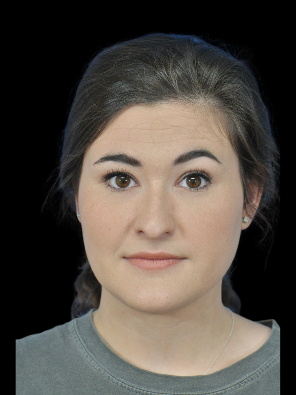 Rhinoplasty Before & After