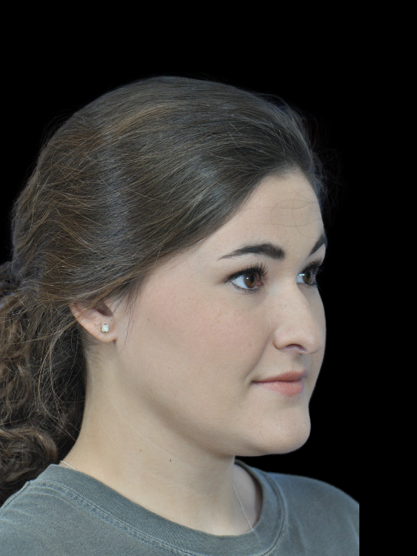 Rhinoplasty Before & After