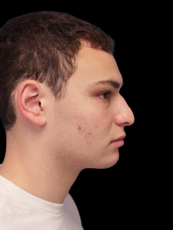 Rhinoplasty Before & After