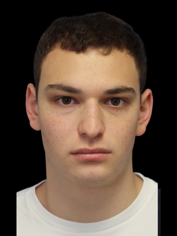 Rhinoplasty Before & After