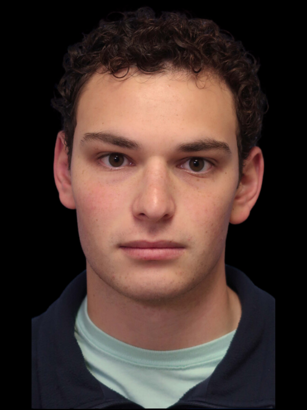 Rhinoplasty Before & After