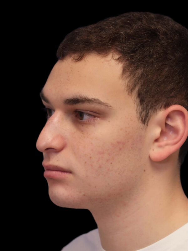 Rhinoplasty Before & After