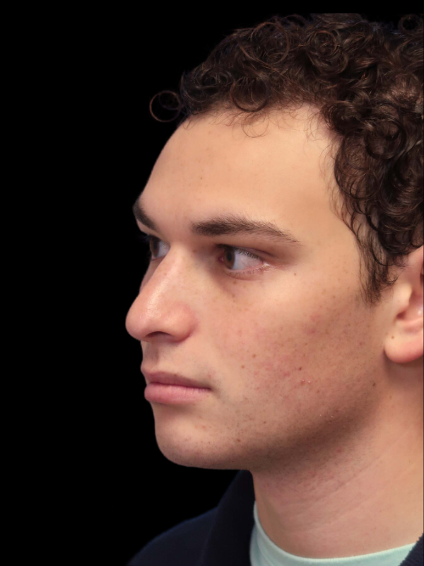 Rhinoplasty Before & After