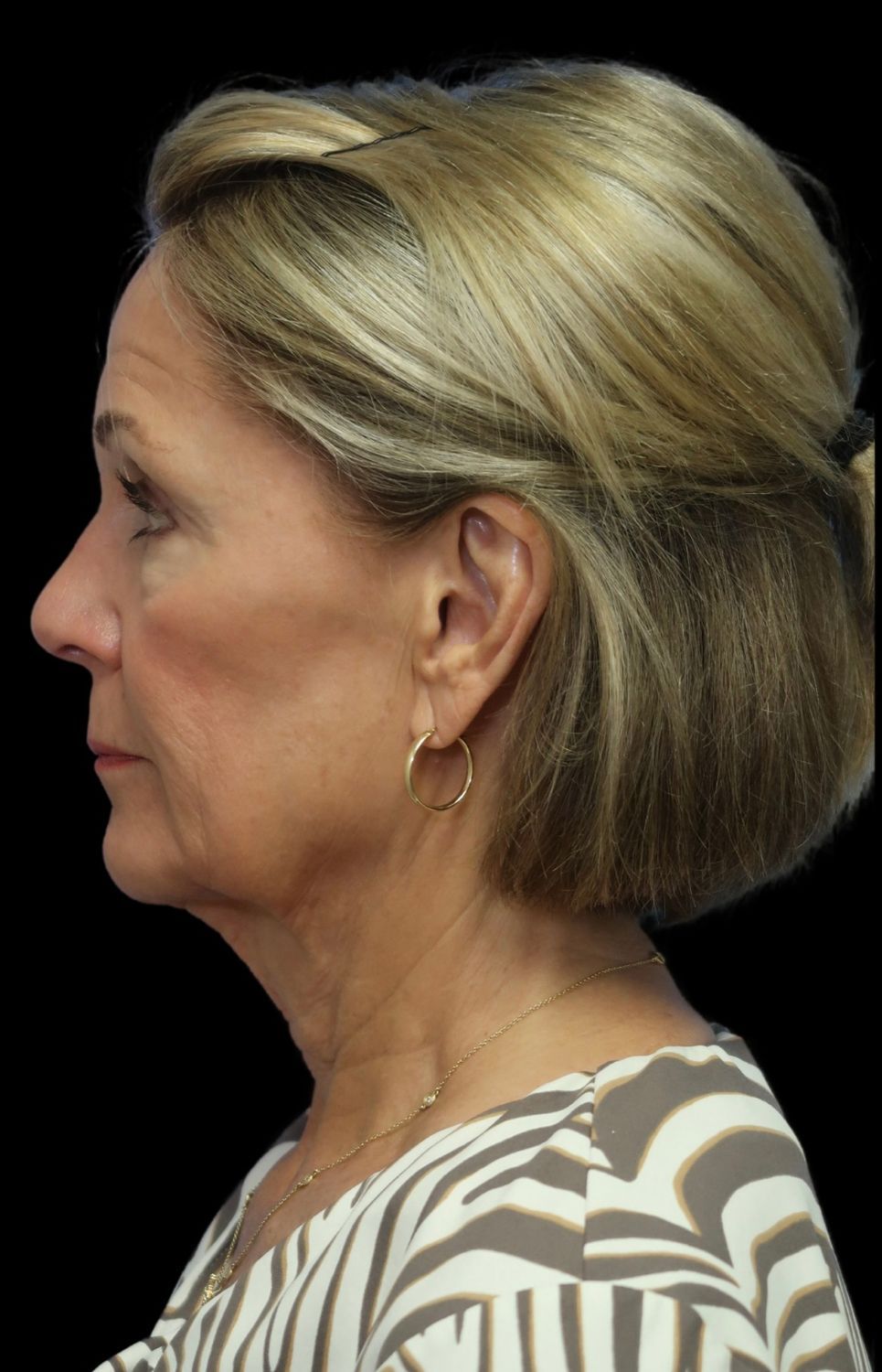 Deep Plane Facelift Gallery Before & After